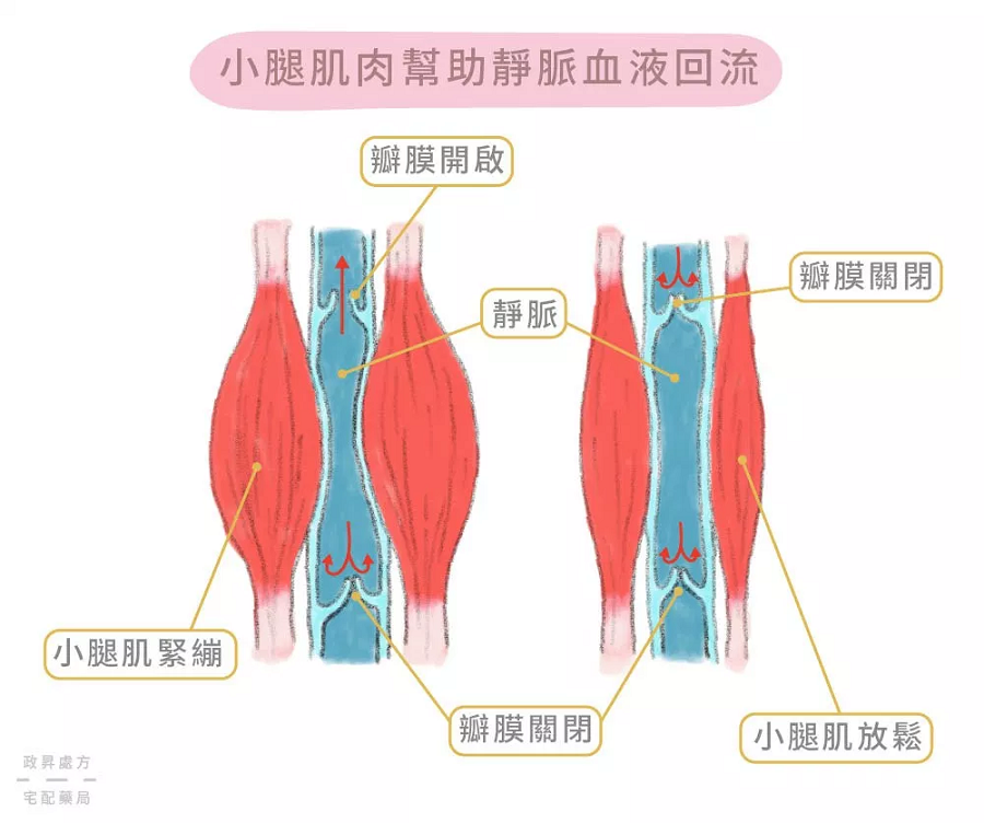 如何预防、改善静脉曲张？