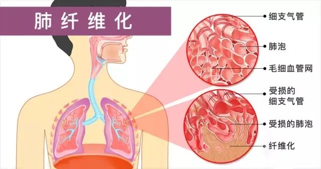 天然水蛭素可(kě)改善肺纤维化？