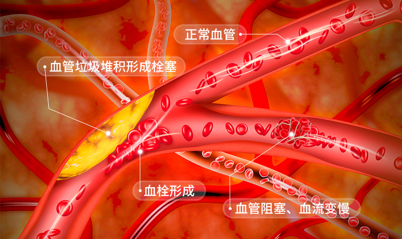 金康道夫案例：水蛭素如何帮助改善脑梗和静脉曲张